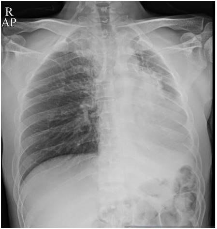 【病例】气道侵袭性肺曲霉菌病1例CT影像表现