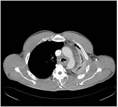 【病例】气道侵袭性肺曲霉菌病1例CT影像表现