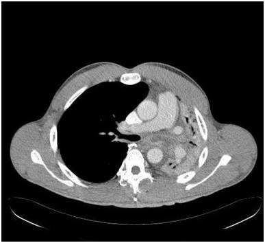 【病例】气道侵袭性肺曲霉菌病1例CT影像表现