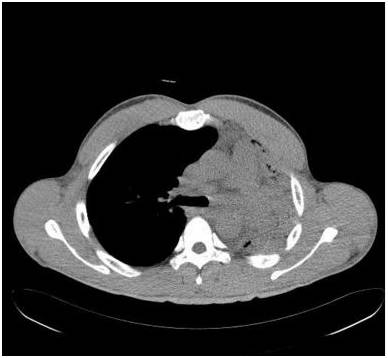 【病例】气道侵袭性肺曲霉菌病1例CT影像表现