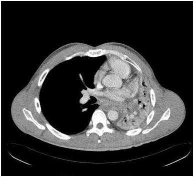 【病例】气道侵袭性肺曲霉菌病1例CT影像表现