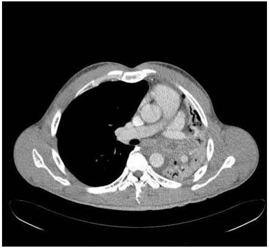 【病例】气道侵袭性肺曲霉菌病1例CT影像表现