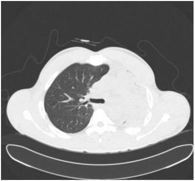 【病例】气道侵袭性肺曲霉菌病1例CT影像表现