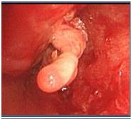 【病例】气道侵袭性肺曲霉菌病1例CT影像表现