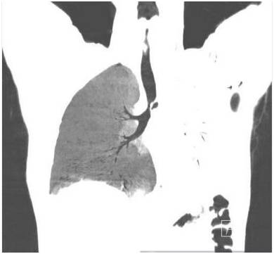 【病例】气道侵袭性肺曲霉菌病1例CT影像表现