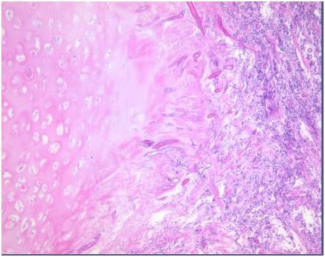 【病例】气道侵袭性肺曲霉菌病1例CT影像表现