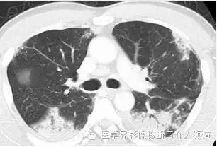 【病例】嗜酸粒细胞性肺炎1例X线CT影像表现 【病例】嗜酸粒细胞性肺炎1例X线CT影像表现