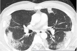 【病例】嗜酸粒细胞性肺炎1例X线CT影像表现 【病例】嗜酸粒细胞性肺炎1例X线CT影像表现