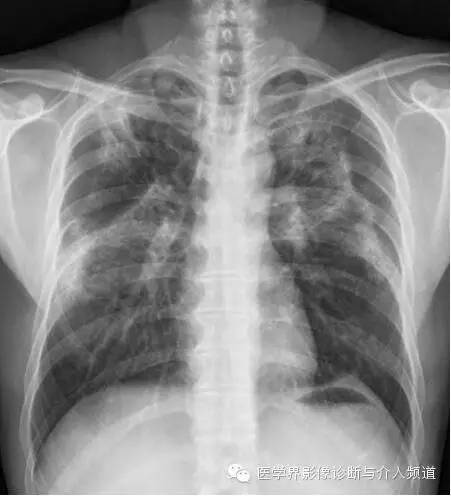 【病例】嗜酸粒细胞性肺炎1例X线CT影像表现 【病例】嗜酸粒细胞性肺炎1例X线CT影像表现