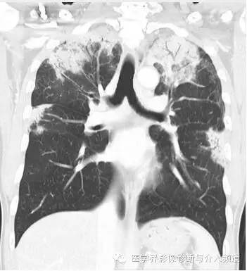 【病例】嗜酸粒细胞性肺炎1例X线CT影像表现 【病例】嗜酸粒细胞性肺炎1例X线CT影像表现