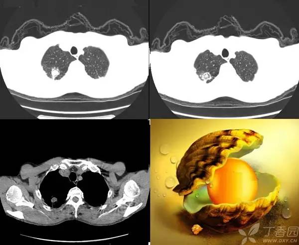 经典影像征解析之呼吸篇 经典影像征解析之呼吸篇