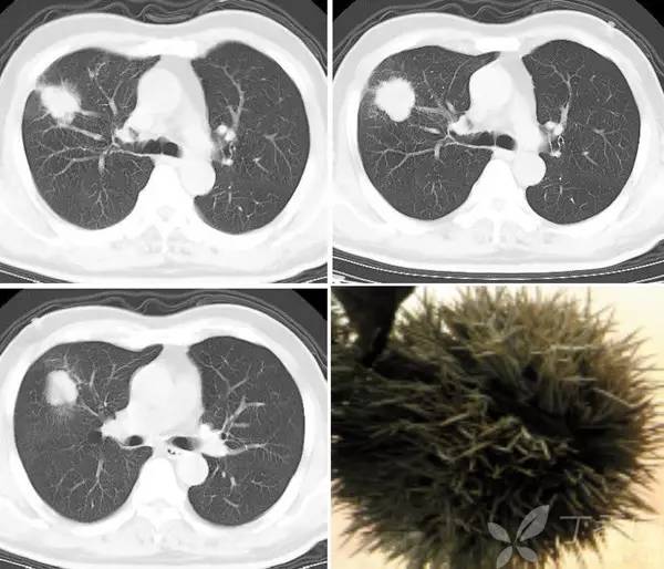 经典影像征解析之呼吸篇 经典影像征解析之呼吸篇