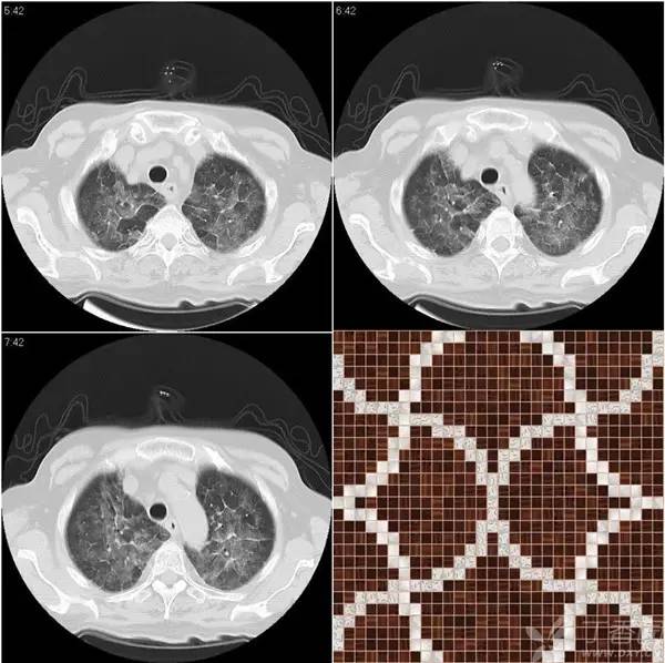 经典影像征解析之呼吸篇 经典影像征解析之呼吸篇