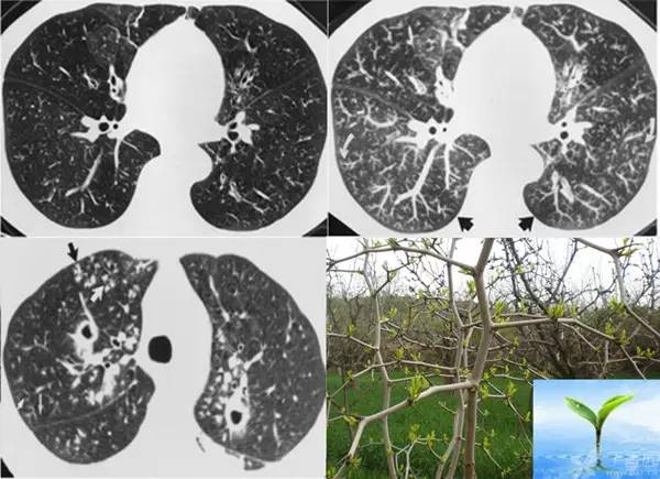 经典影像征解析之呼吸篇 经典影像征解析之呼吸篇