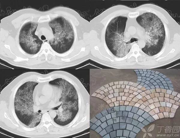 经典影像征解析之呼吸篇 经典影像征解析之呼吸篇