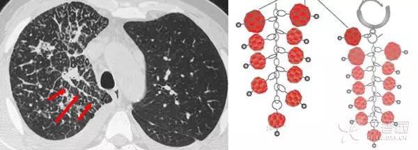 经典影像征解析之呼吸篇 经典影像征解析之呼吸篇