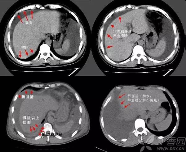 经典影像征解析之呼吸篇 经典影像征解析之呼吸篇