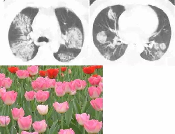 经典影像征解析之呼吸篇 经典影像征解析之呼吸篇