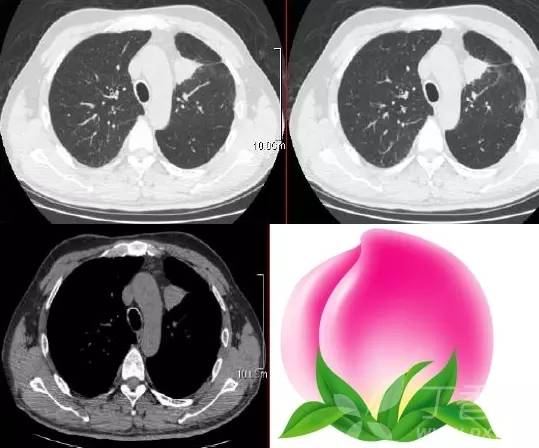 经典影像征解析之呼吸篇 经典影像征解析之呼吸篇