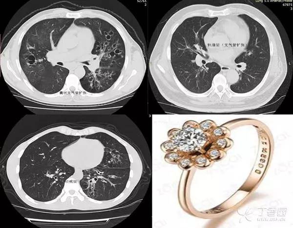 经典影像征解析之呼吸篇 经典影像征解析之呼吸篇