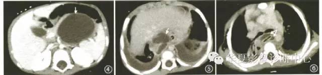 【病例】胰胸瘘2例影像表现