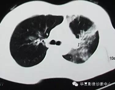 【病例】慢性嗜酸细胞性肺炎1例CT影像表现