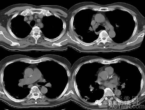 【病例】慢性嗜酸细胞性肺炎1例CT影像表现