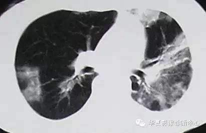 【病例】慢性嗜酸细胞性肺炎1例CT影像表现