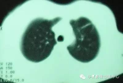 【病例】慢性嗜酸细胞性肺炎1例CT影像表现