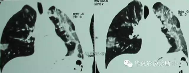 【病例】慢性嗜酸细胞性肺炎1例CT影像表现