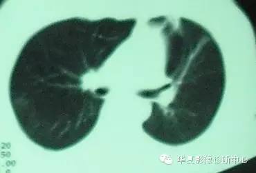 【病例】慢性嗜酸细胞性肺炎1例CT影像表现