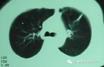 【病例】慢性嗜酸细胞性肺炎1例CT影像表现