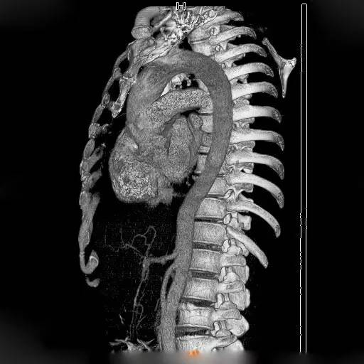 主动脉壁内血肿 主动脉壁内血肿