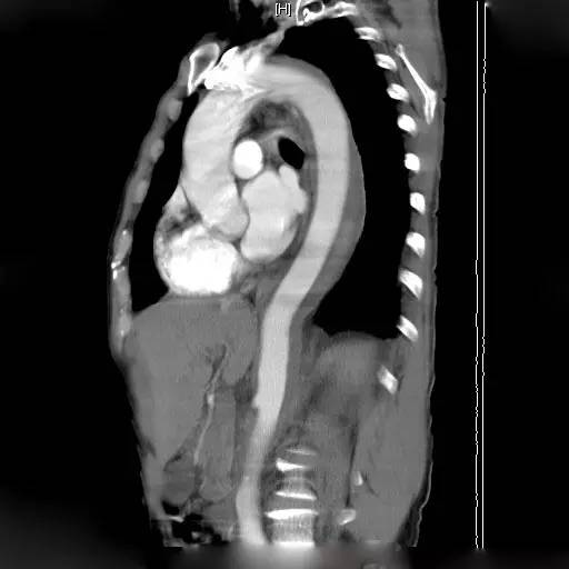 主动脉壁内血肿 主动脉壁内血肿