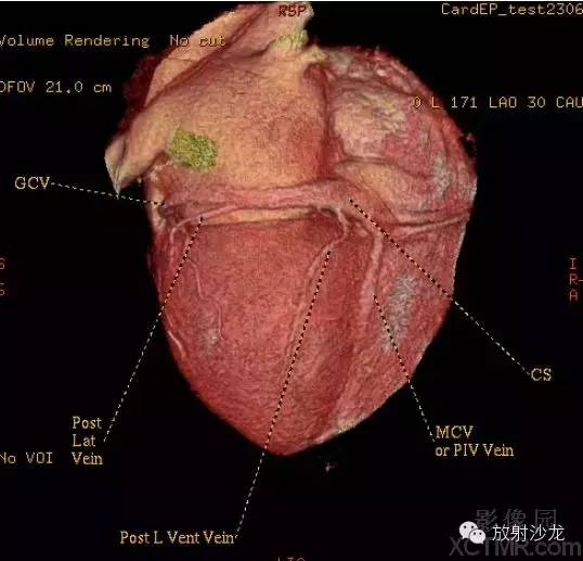 心脏冠状动脉CT解剖中文详细标注