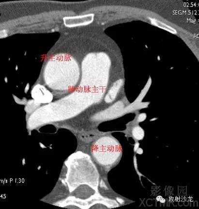 心脏冠状动脉CT解剖中文详细标注