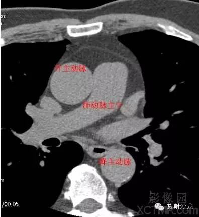 心脏冠状动脉CT解剖中文详细标注