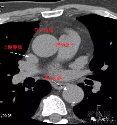 心脏冠状动脉CT解剖中文详细标注