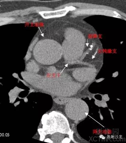 心脏冠状动脉CT解剖中文详细标注