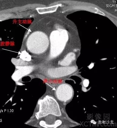 心脏冠状动脉CT解剖中文详细标注