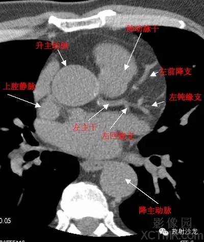 心脏冠状动脉CT解剖中文详细标注