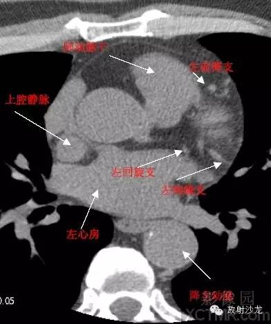 心脏冠状动脉CT解剖中文详细标注