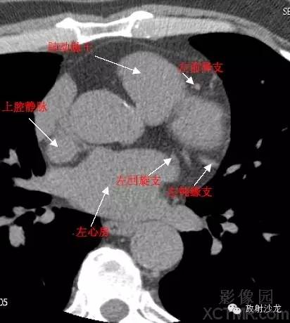 心脏冠状动脉CT解剖中文详细标注