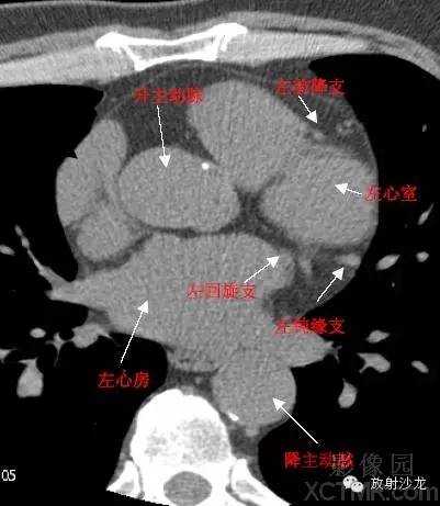 心脏冠状动脉CT解剖中文详细标注