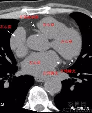 心脏冠状动脉CT解剖中文详细标注