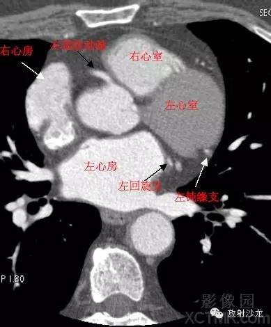 心脏冠状动脉CT解剖中文详细标注