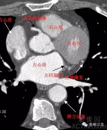 心脏冠状动脉CT解剖中文详细标注