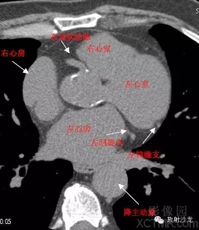 心脏冠状动脉CT解剖中文详细标注