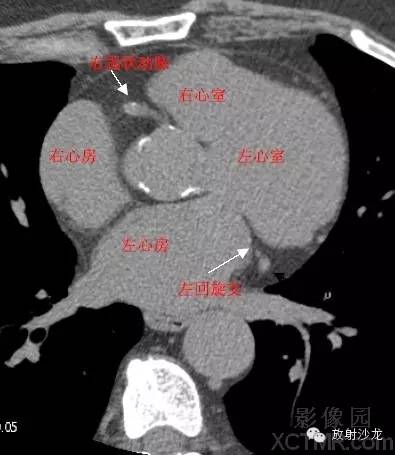 心脏冠状动脉CT解剖中文详细标注