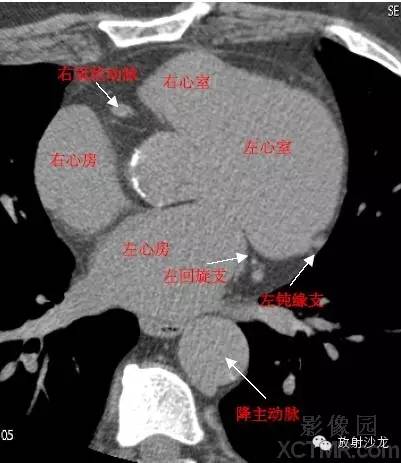 心脏冠状动脉CT解剖中文详细标注